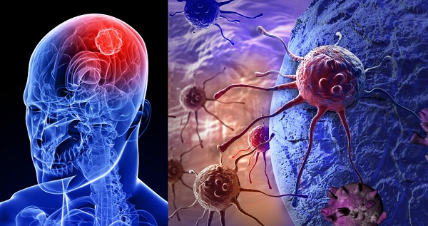 Best treatment of Neuromuscular Disorder